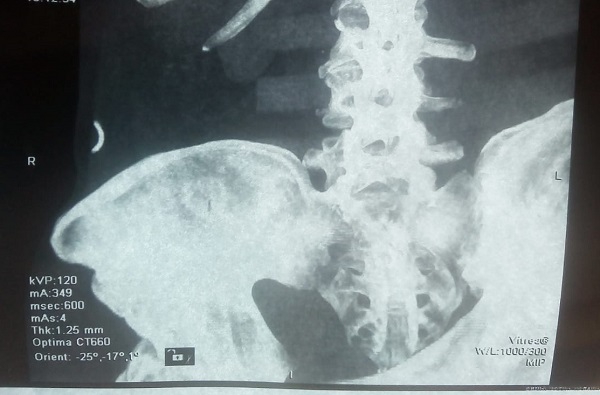 Рентгеновский снимок, на котором обломок иглы отчетливо виден. Предстоят месяцы разбирательств, после которых станет ясно, как инородное тело попало в организм человека
